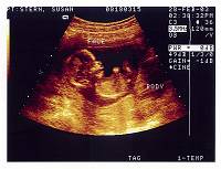 a) Ultrasound Pictures